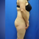 before surgery