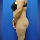 before surgery