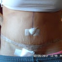 One week post op!