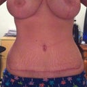 4 months post op