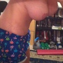 4 months post op