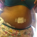 2-14-2013 tummy lipo