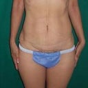 Ultrashape