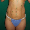 Ultrashape