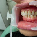 before invisalign