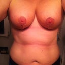 2 weeks left side still very swollen