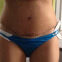 Blurry, and excuse the panty liner (that's because for some reason I feel like something snags on my clothes), and the other gauze is where they took the drain out today - only 11 days out