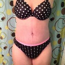 Very swollen PO day13