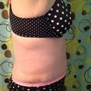 Very swollen PO day 13