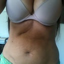Pre-op.  I also have a gall bladder scar which my PS says will not be a problem