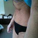 Side view pre-op.