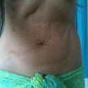 Another front view pre-op
