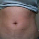 Small bruises on lower abs 8 days after procedure