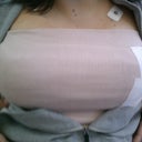 Few hours after surgery. They still look big because they are swollen. But they are not sagging!!