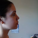 6 months post-op