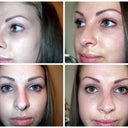 My most hated view - the 'V' shaped collumellar. These pics are 2 months post surgery and I'm still quite rigid and swollen, so hopefully this will reduce further, though I am already very happy.