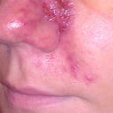 Initial viral infection after Radiesse (began to develop the next day)