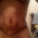 Scar day 16 post op a bit swollen still