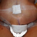 Post Opt Day 5...still swollen but, I can see the results already!! I am AMAZED!!!