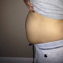before tummy tuck nasty