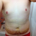 Day 5 Post Op - Still some swelling but I look completely different then I did prior to getting it.