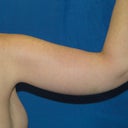 Brachioplasty