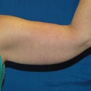 Brachioplasty