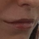 After first treatment, you can kind of see the "duck lip" and the corners of my mouth looked like the joker