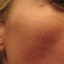 after laser