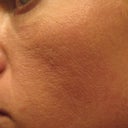 after laser