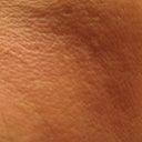 after laser