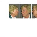 Before my procedure- I had the neck procedure where they took away my turkey nech and tightened my jawls