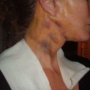 2 weeks after surgery still very bruised and pain around ears
