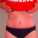 Here I am at 2 days shy of 15 weeks post op.  A bit grainy but you can see my tummy.