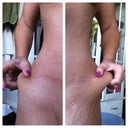before hip revision