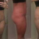 Day 11 post op. LOW scar, still covered in steristrip. Stitches are out of thighs. Still scrubbing to get the ink off but boy is that ink hard to get off! The hole from the drain is scabbed over right in the middle below the incision.