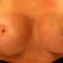 Gross scar 2 months