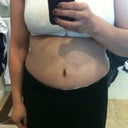 13 days PO, still swollen