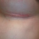 Left incision right after tapes being removed 11 days post op.