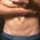 PRE OP - Skin Pulled Up