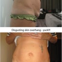 Before - I used to have to tuck the lower overhang of skin into my underwear and I never wore fitted dresses etc incase the bulge showed!