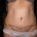 11 weeks post op