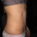 11 weeks post op