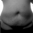 Front 1 week tummy tuck, liposuction pre op......This is really horrible..