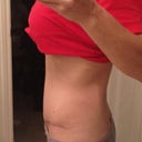 8.5 weeks post op, still not quite as flat as I was (I used to be concave between my hip bones) but honestly, after how scared I was that I would stay look pre go/distended...I'm fine with this.