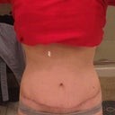 Front view, its hard to tell, but the scar has moved WAY down
