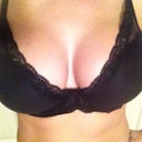 Day 18 after surgery with bra