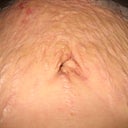 I know I still have some swelling causing the marks to puff out, but once that dissipates it will just be even more wrinkly.  So fugly.