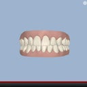 "After" End shot of my clincheck video.