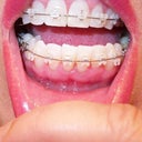 I have worries over my lower gum-line receding!  The braces are also pulling my teeth up from the socket.  If this is a serious issue then I must do something.  Otherwise my gums seems healthy.